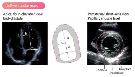 lv es volume|Heart Left Ventricle Volume .